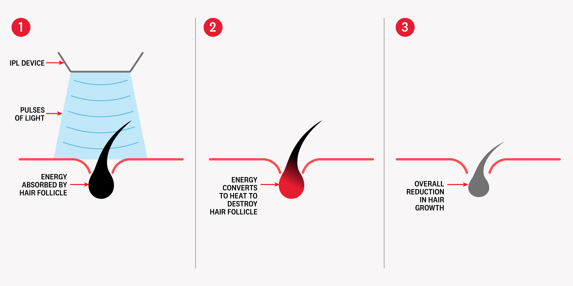Diagram showing IPL device process: light pulses, energy absorbed, heat destroys hair follicle.