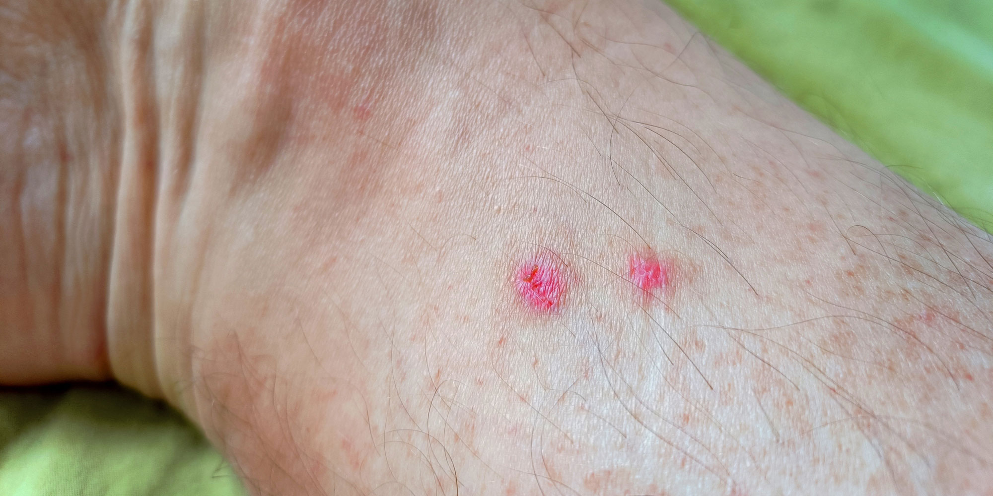 Spider bite