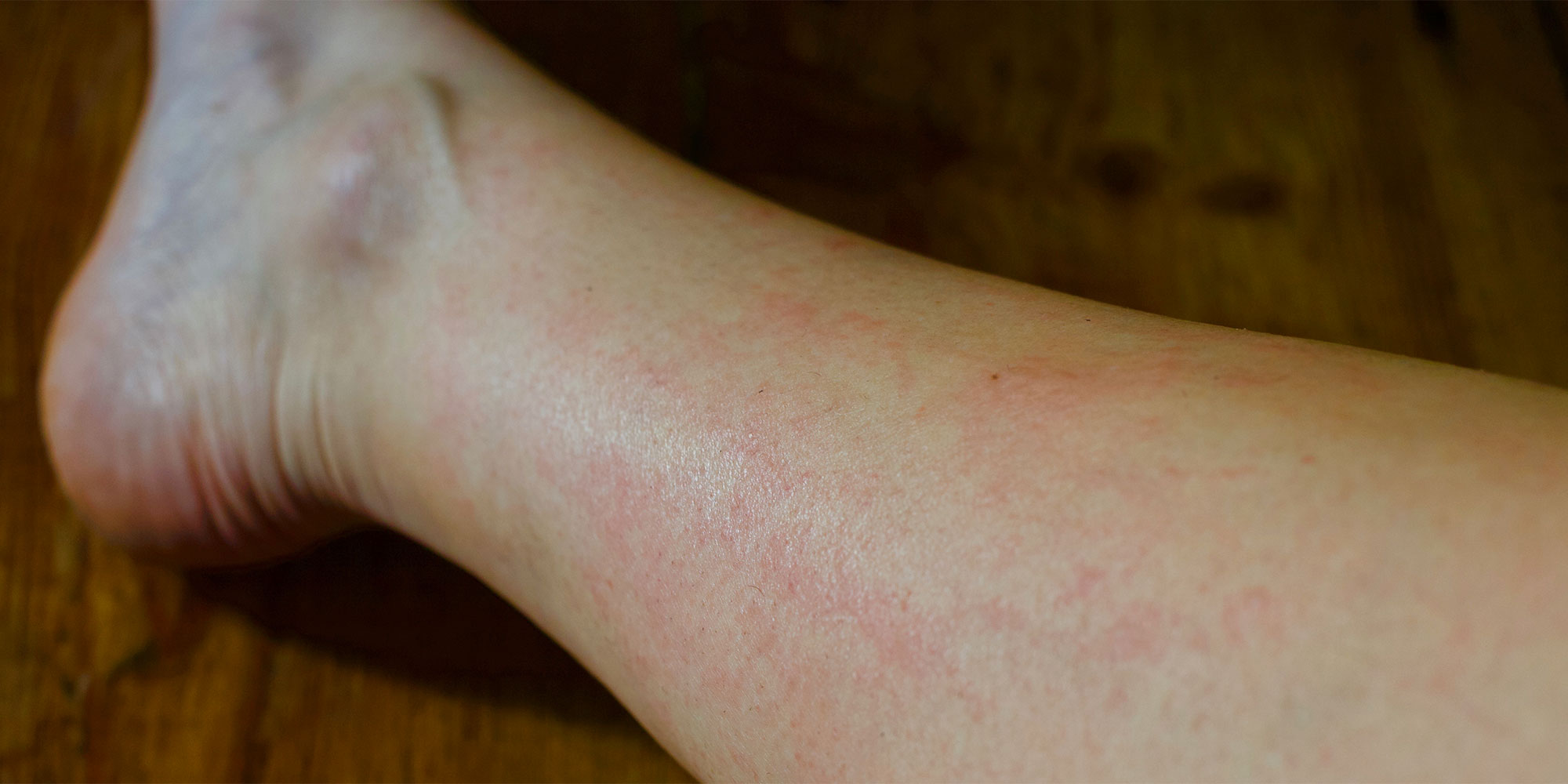 Razor burn on lower leg
