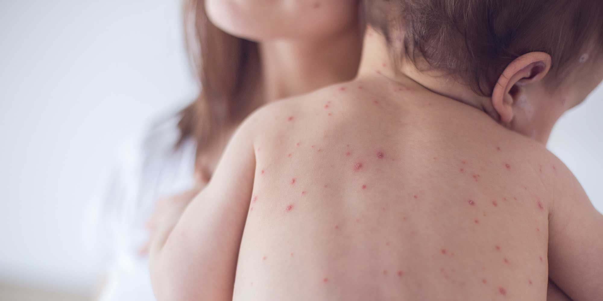 A baby with chicken pox spots