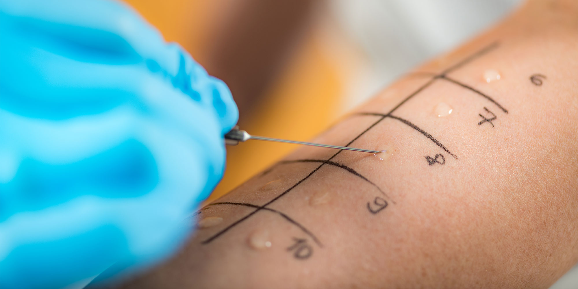 Skin prick allergy test