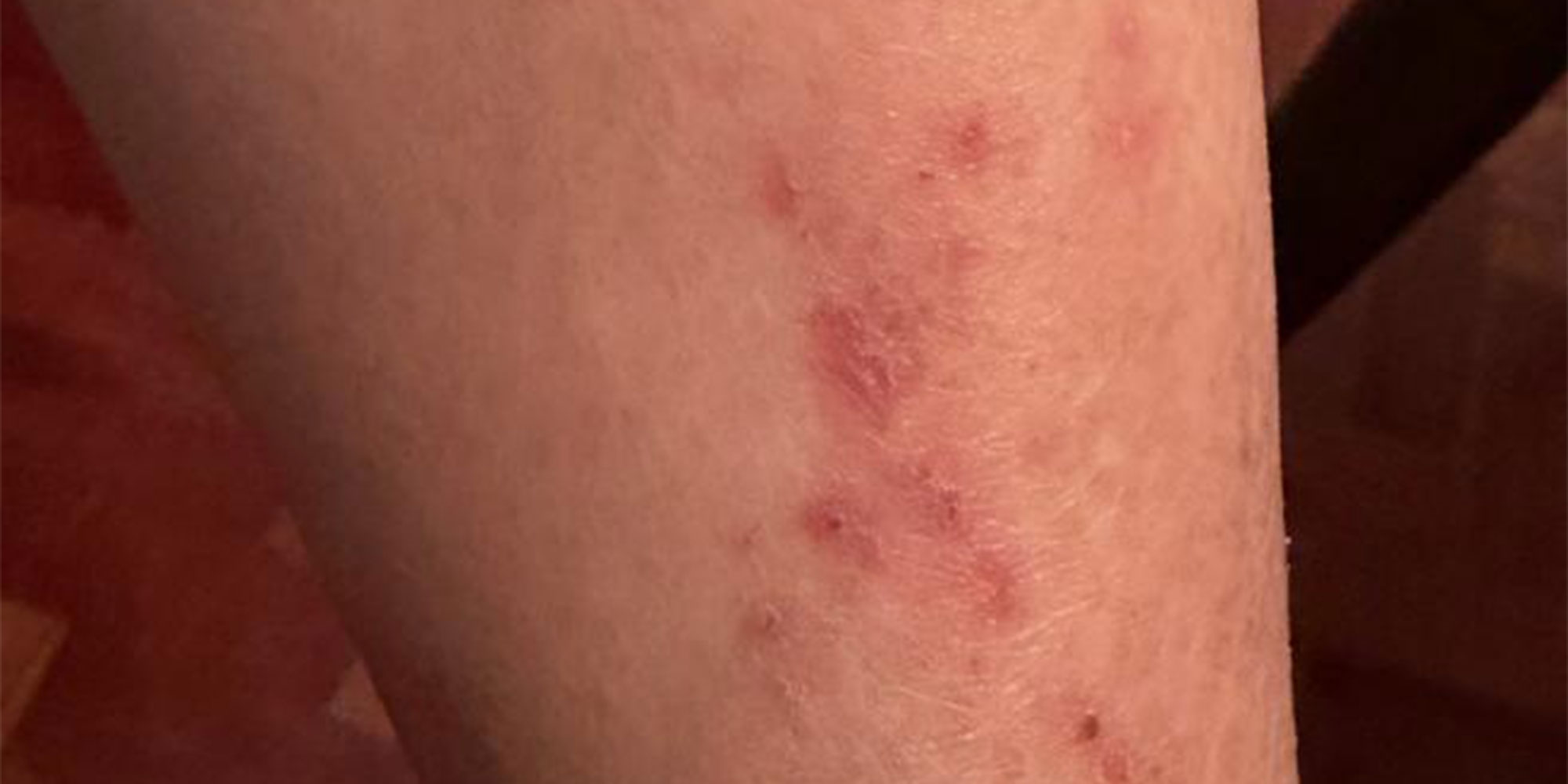 Jasbinder skin irritation