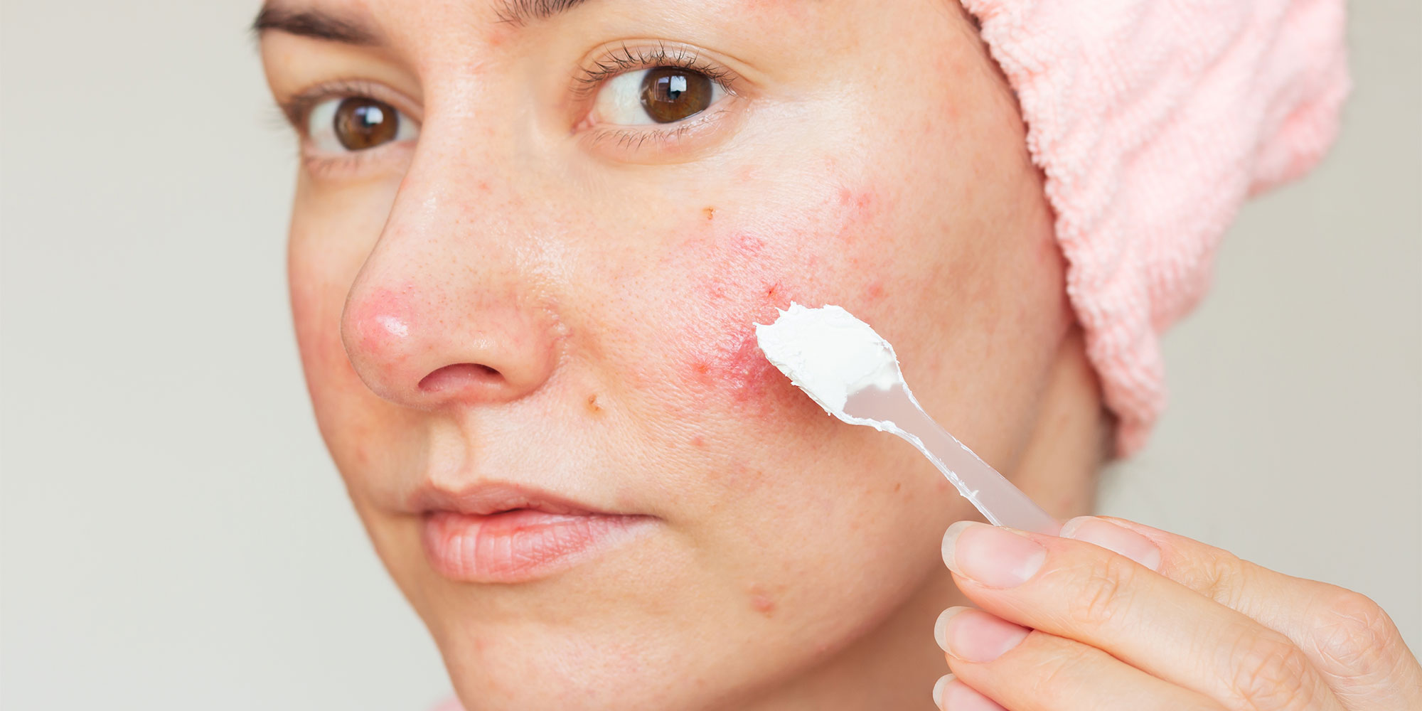 Woman applying skincare for redness