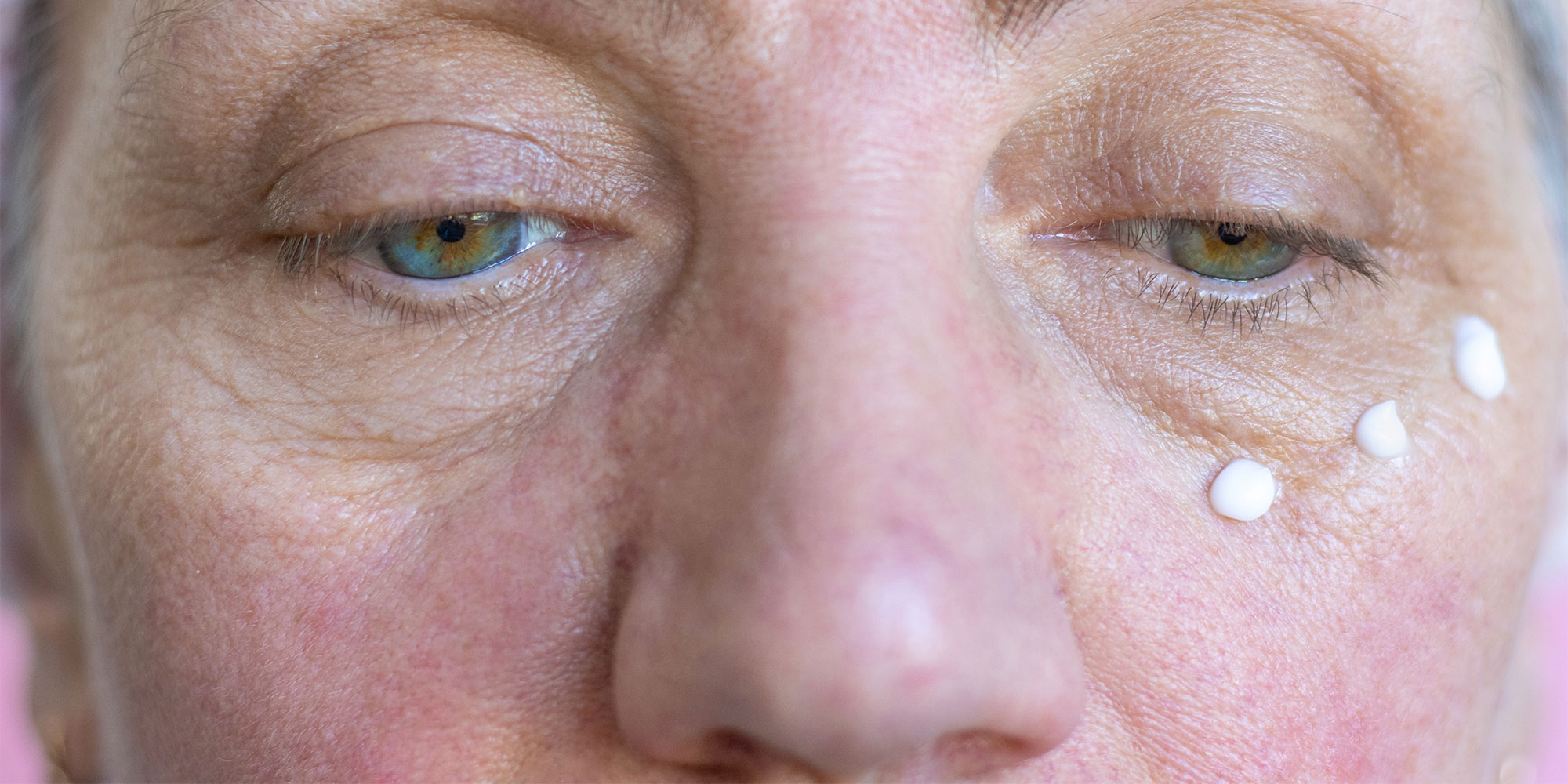 Woman applying moisturiser to redness