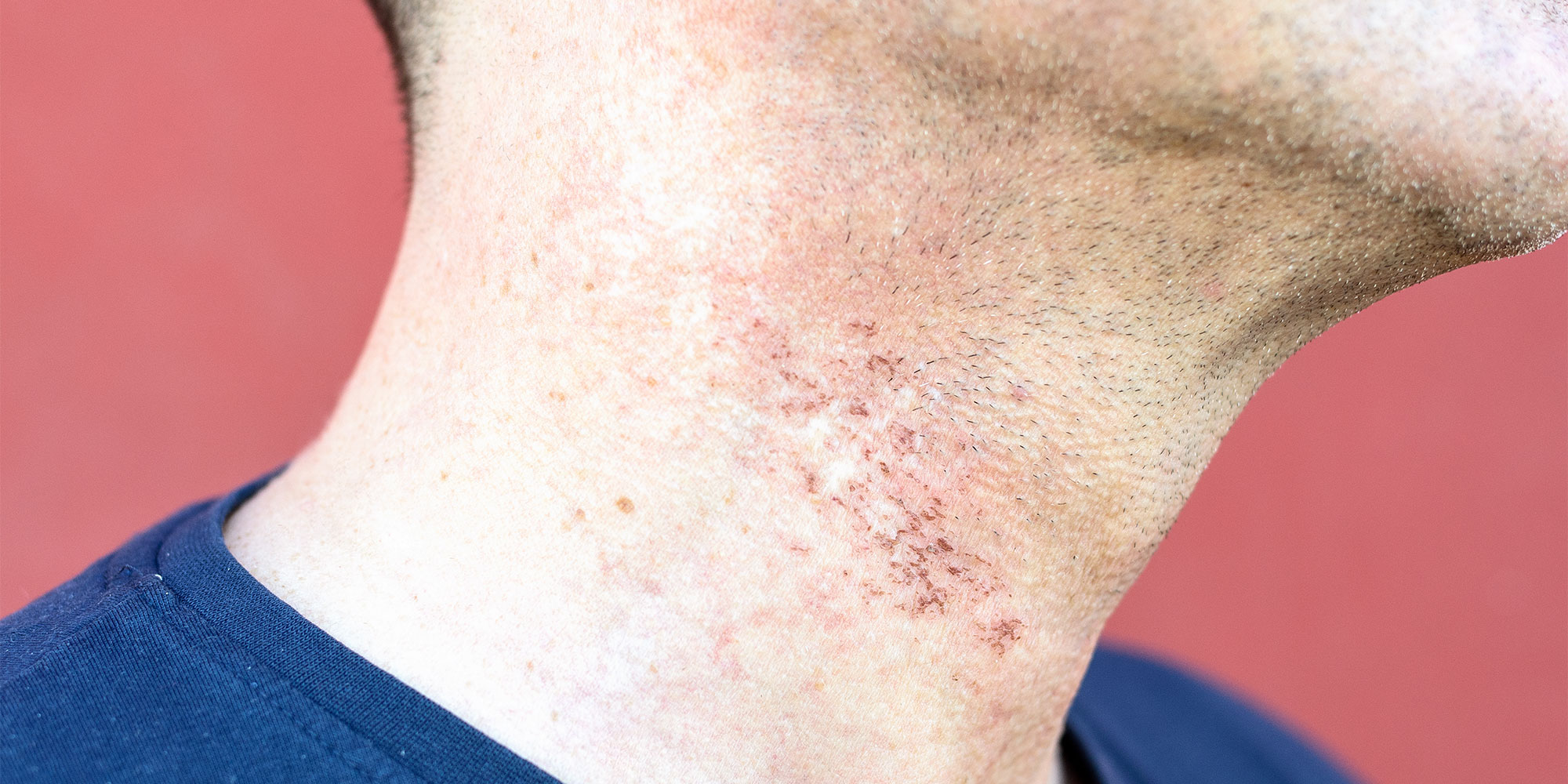 Red razor burn on neck