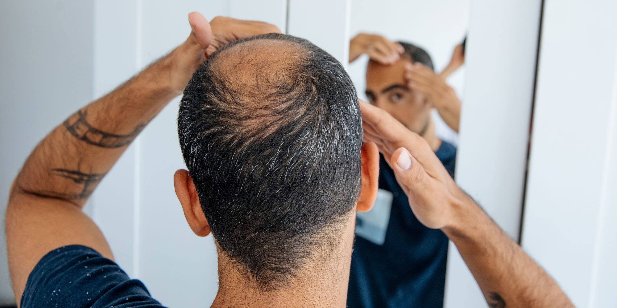 Man with hair loss